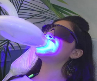 Lasersko beljenje zuba + GRATIS stomatološki pregled