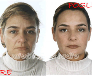 Beauty Defect Repair tretman lica