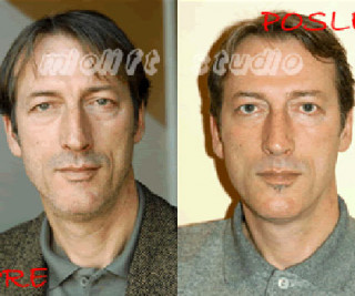Beauty Defect Repair tretman lica