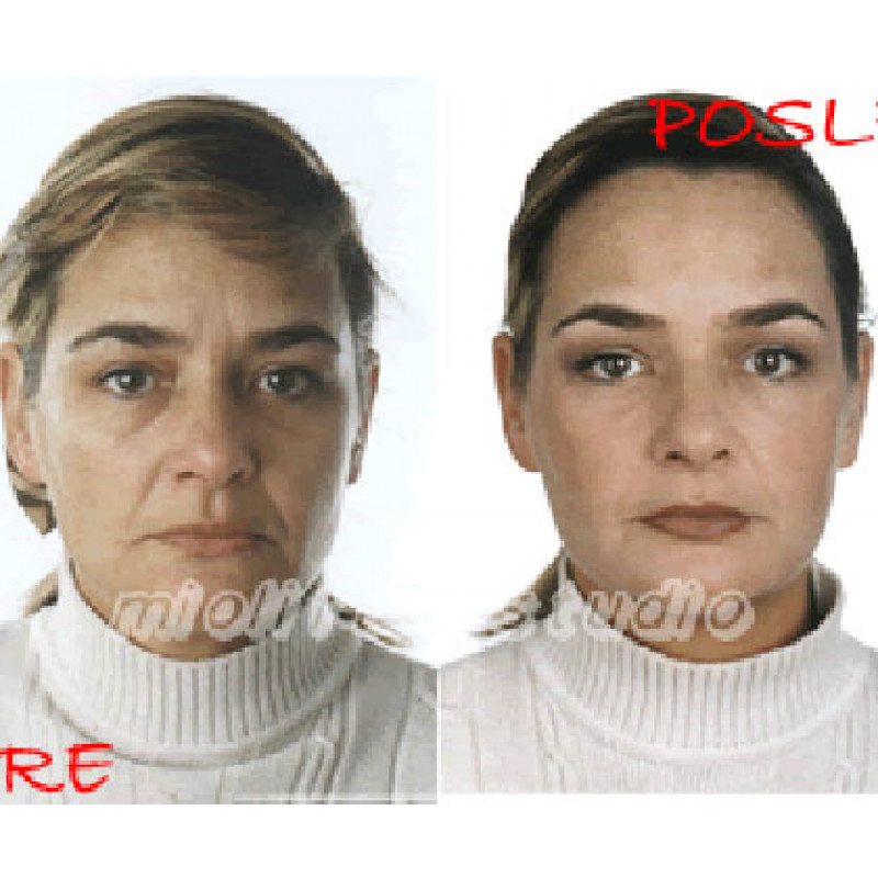 Beauty Defect Repair tretman lica