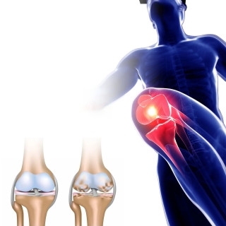 Arthritis Cream – krema protiv bolova u zglobovima