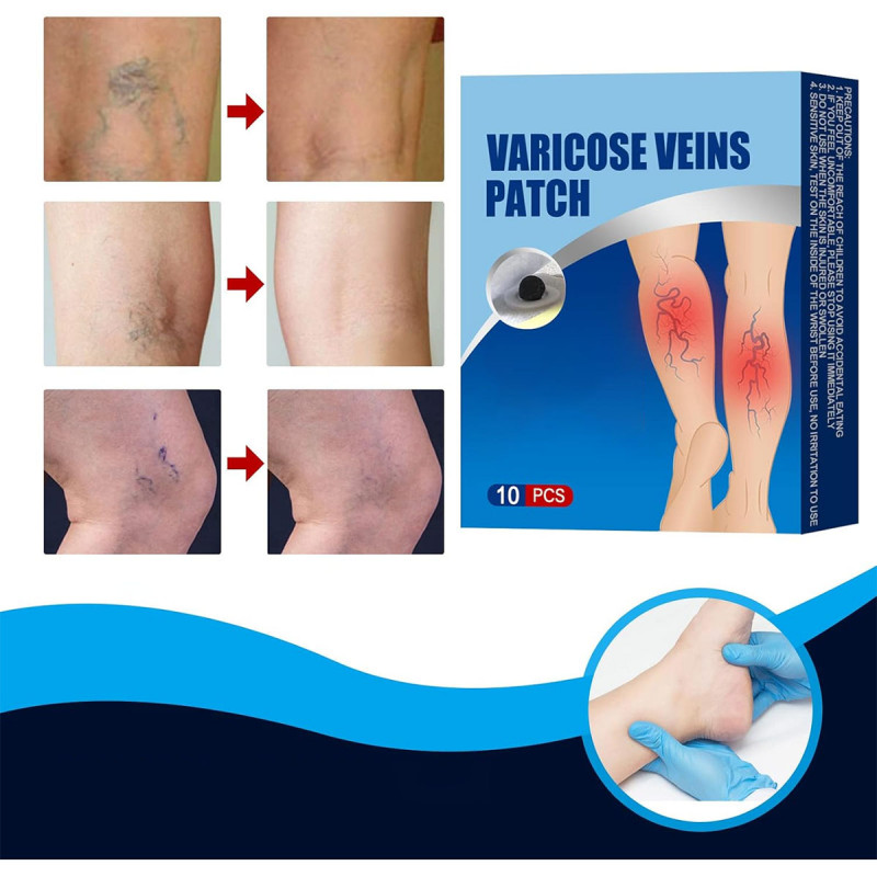 Flasteri za proširene vene i cirkulaciju