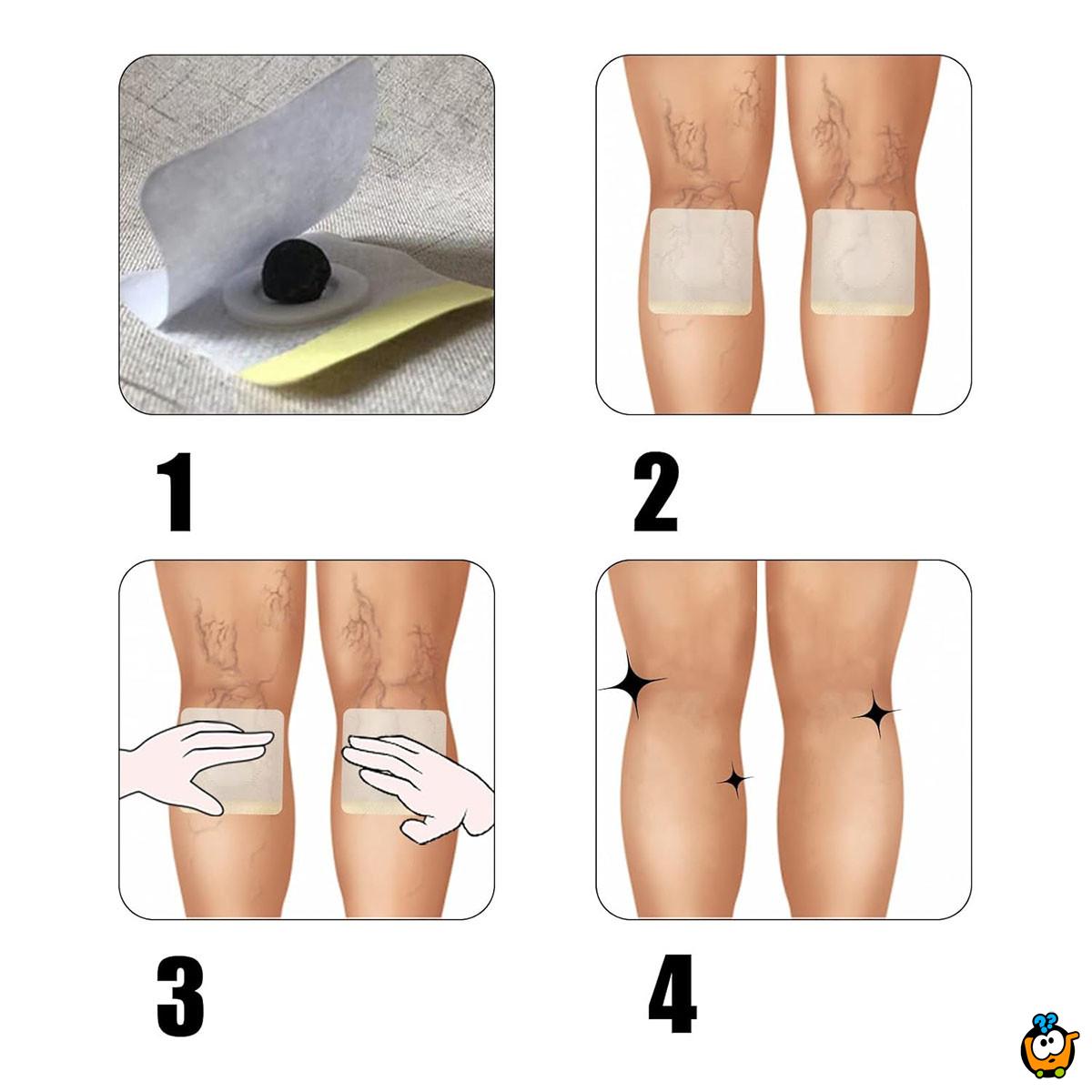 Flasteri za proširene vene i cirkulaciju